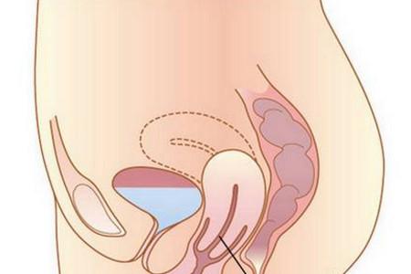 子宫脱垂可以怀孕吗？子宫脱垂的危害