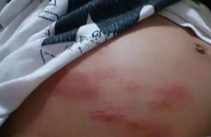 孕期本以为只是肚子痒，没想到事情居然那么严重！