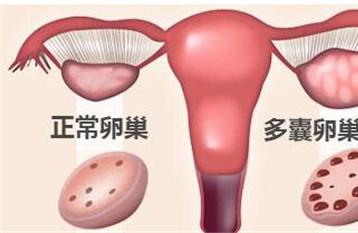 多囊卵巢综合症能治好吗 多囊卵巢其实并不可怕