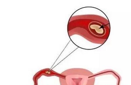 怀孕乱吃事后药想流产，输卵管破裂出血险丧命