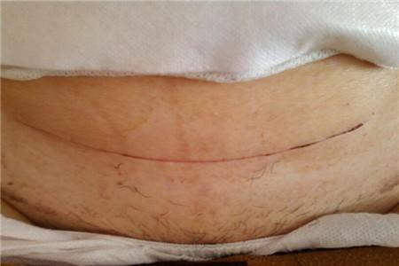 剖腹产伤口纱布几天可以拿掉 纱布去除时间别太早