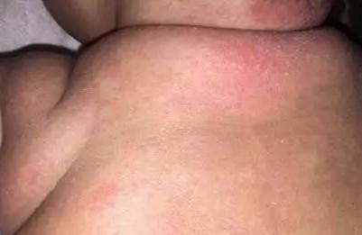 湿疹，痱子，急疹，荨麻疹，婴儿痤疮如何简单区分？该怎么治疗？