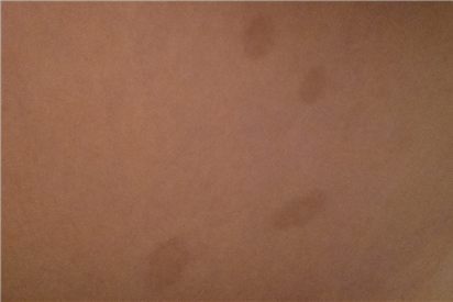 汗斑图片 原来这就是汗斑