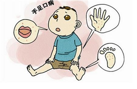 得了手足口病，咽峡炎怎么治最有效