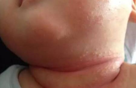 宝宝淹脖子了该怎么办呢？妈妈们还在干着急吗？