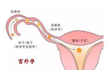宫外孕胎儿不可能存活，一经发现及时手术！