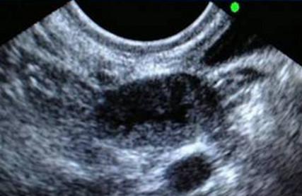 试管婴儿过程中怎么监测排卵？