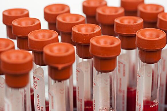 总胆红素多少算偏高 总胆红素高多少不正常