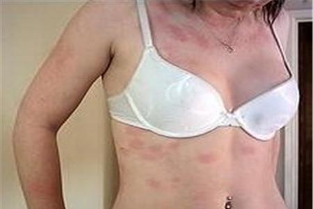 产后风疹的症状图片 教你细辨风疹