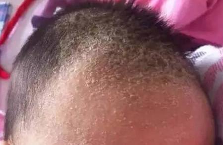 如何简单去除宝宝头上的乳痂，这些乳痂抠还是不抠？