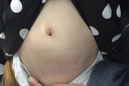 小孩为什么得阑尾炎？得了阑尾炎怎么办