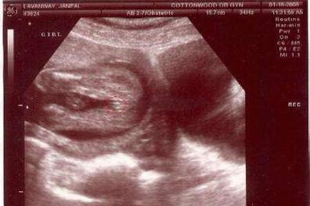 孕两个月女宝宝的孕囊图片 孕囊隐藏的秘密要知晓