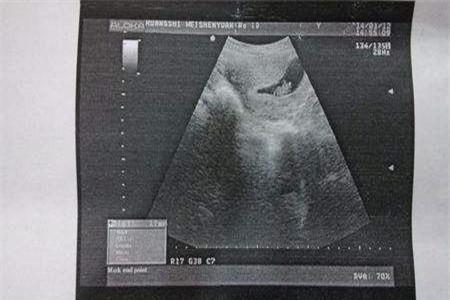 怀男孩两个月孕囊图片 你所不知道的孕囊形状