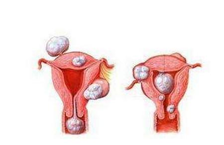 妊娠期间发现有子宫肌瘤该怎么办？