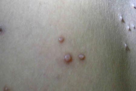 宝宝身上长“水瘊子”了？宝宝长“水猴子”的原因是什么呢？