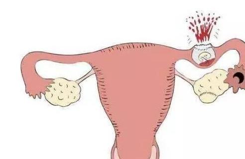 孕妇怀疑自己是宫外孕，如何判断是不是？