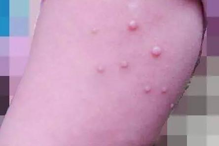 传染性软疣是怎么引起的？宝宝得了传染性软疣怎么治疗？