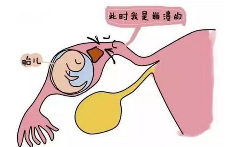 这五种女性最容易患宫外孕？你中招了吗？