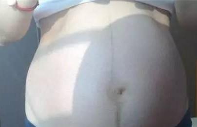 孕妇肚子上的黑线是什么？如何预防长妊娠线？