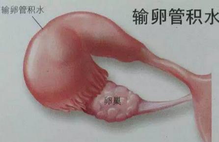 输卵管积水对备孕的危害大不大？输卵管积水的治疗方法！