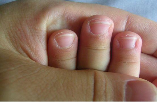 宝宝手指脚趾脱皮是怎么回事 是缺维生素吗？要补吗？
