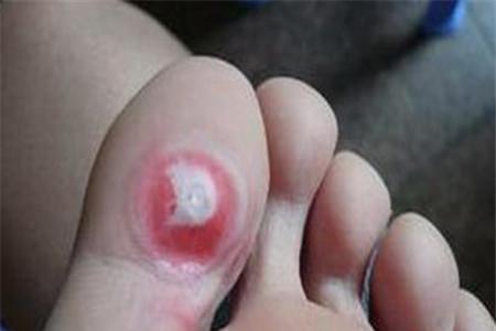 孕妇脚上长鸡眼怎么办 这些方法让你远离它