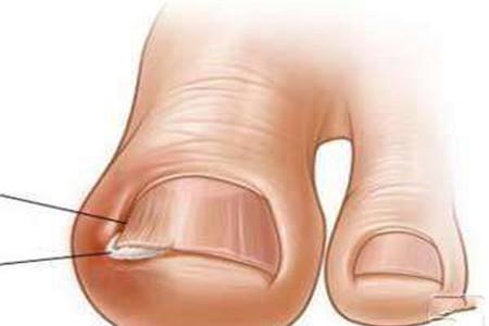 脚指甲往肉里长怎么办 让你远离脚疼烦恼