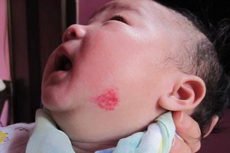 宝宝血管痣是怎么回事，宝妈要注意了，其实是血管瘤
