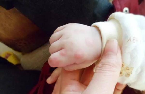 手足口病高发期，家长要如何预防和护理？