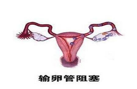 为什么需要进行输卵管检查？输卵管检查常用的方法有哪些呢？