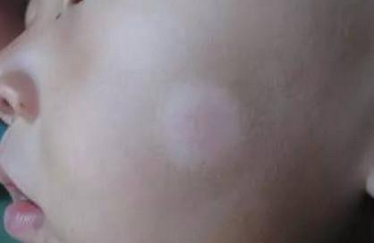 宝宝脸上长白斑是怎么回事？是肚子里有蛔虫有关吗