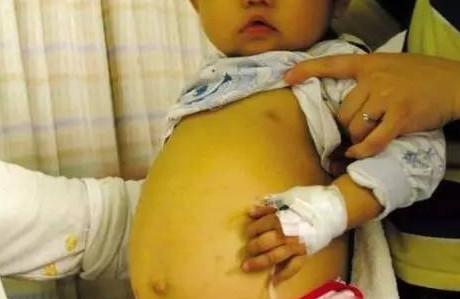 三岁小孩吃多了这些食物导致肠穿孔，家长你还在惯着孩子吗？