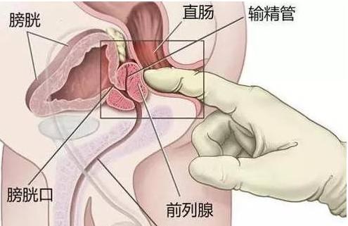 前列腺肥大与前列腺炎的区别，你能分清吗？