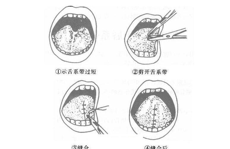 宝宝舌系带短是什么原因造成的 什么原因引起舌系带短