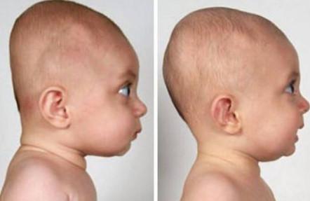 宝宝的头睡扁了，会不会影响智商水平呢？！