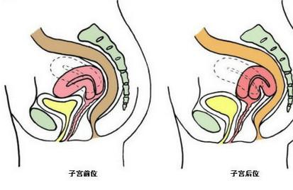 子宫前后位对怀孕有什么影响？子宫后位同房要采取什么姿势？