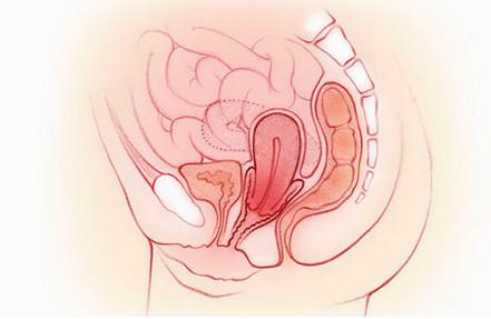 子宫脱垂都有哪些症状？产后子宫脱垂怎么办？