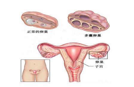 多囊卵巢综合征对女性有哪些危害？主要症状有哪些？