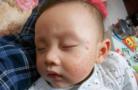 揭秘婴儿湿疹为什么容易反复发作？
