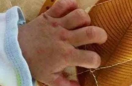 宝宝出现了“手足口病”怎么办？家长请一定要重视！