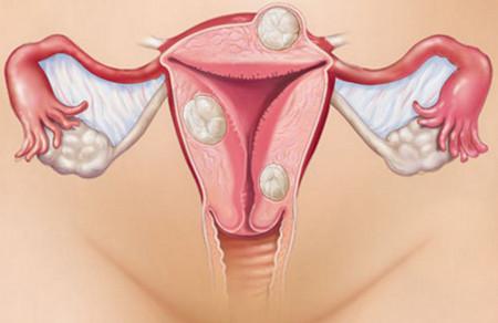 女性痛经是什么原因导致的？警惕子宫内膜异位症！
