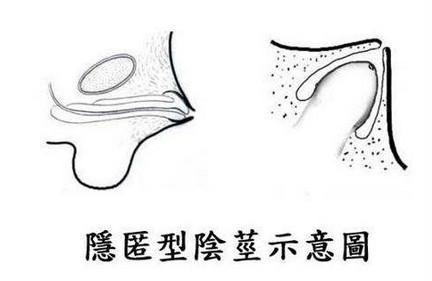隐匿性阴茎是什么？引起隐匿性阴茎的原因