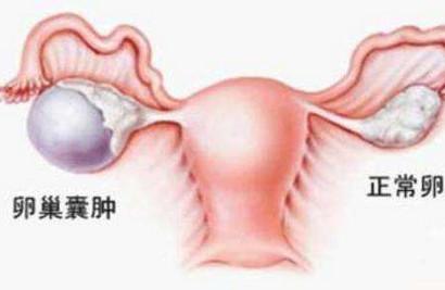 什么是卵巢巧克力囊肿？巧克力囊肿对女性生育力有哪些影响？