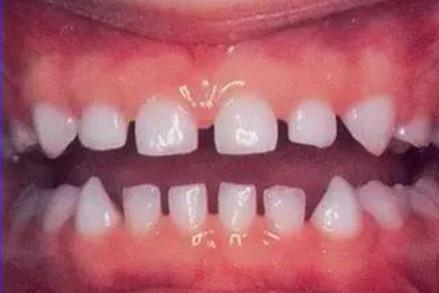 宝宝的乳牙恒牙替换的时候应该注意这六大问题