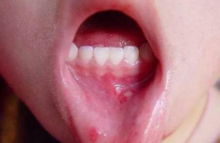 宝宝食欲不振怎么回事？注意一下4种突袭的口腔疾病