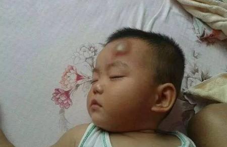 孩子摔到头后怎么办？磕到头后该怎么处理