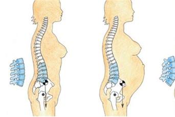 盆骨前倾会影响怀孕吗 骨盆前倾对怀孕的影响一定要注意
