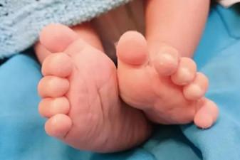 小儿夹腿综合征是怎么回事？宝宝这么小就有性欲了吗？