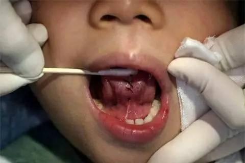 宝宝4岁说话不清楚被骂是大舌头是怎么回事？