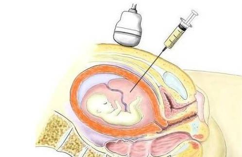 孕期做羊水穿刺会影响胎儿吗？羊水穿刺注意事项